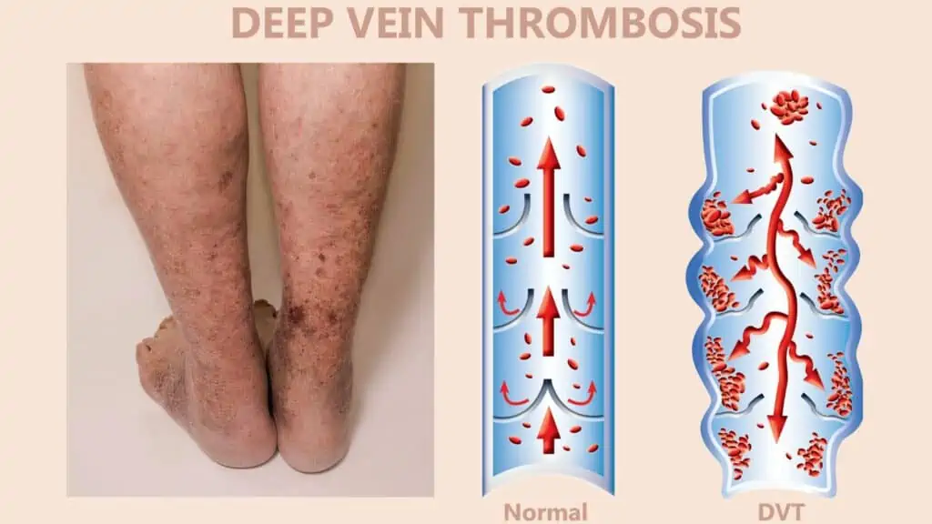 Advantages of inflatable footrests - dvt