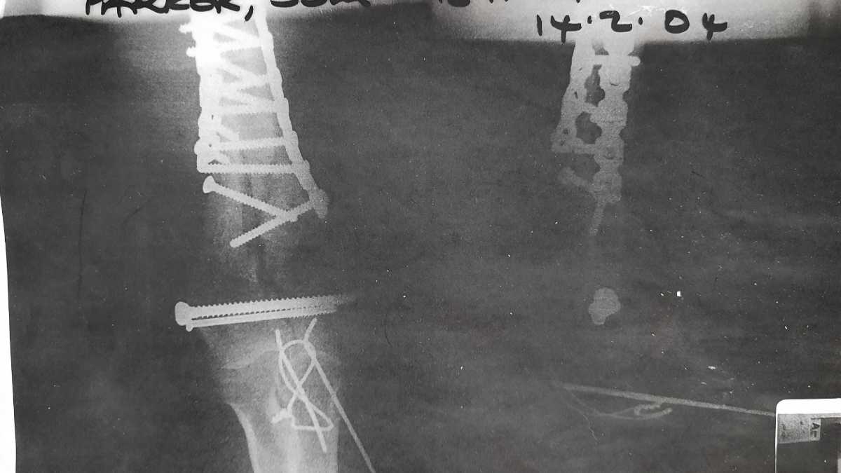 Does Titanium Set Off Metal Detectors at Airport Security?